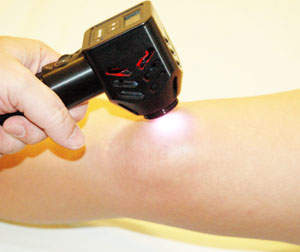 Picture of Nanobeam 940 used on a knee.